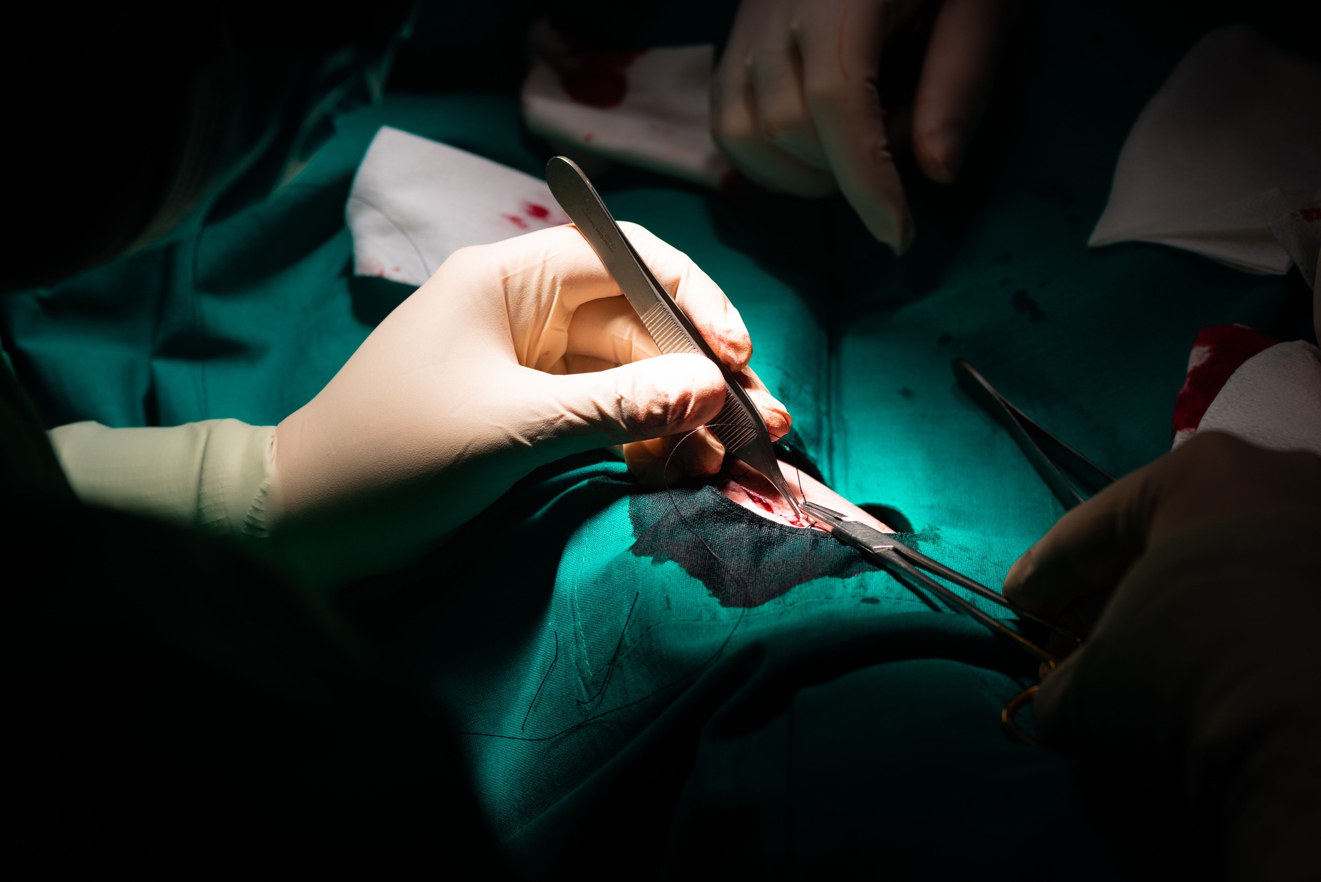 Close-up of a surgeon's hands closing the skin after removing a dermatological lesion